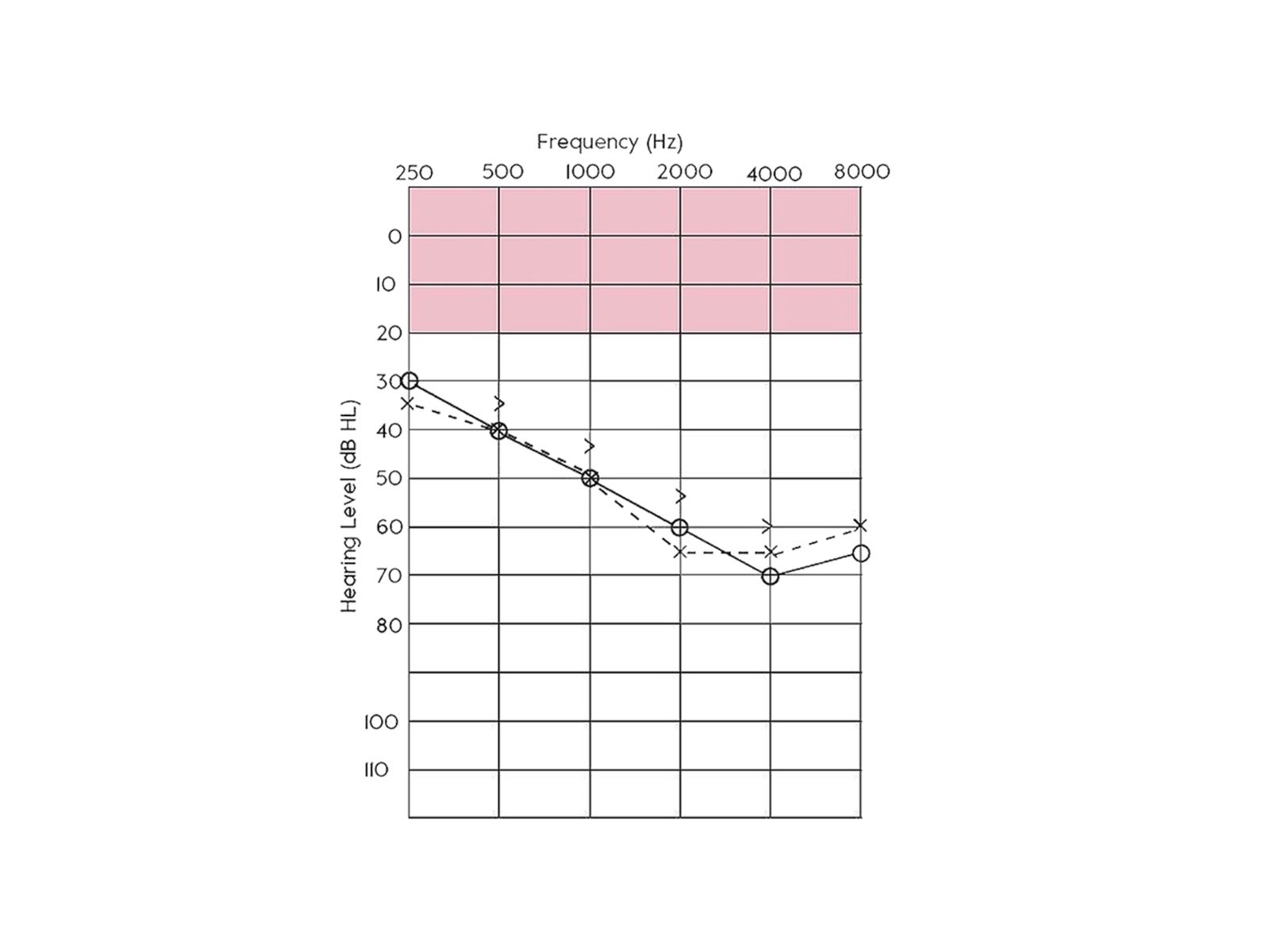 What Is An Audiogram Hearing Services Amplifon Au