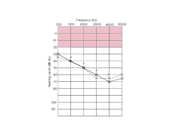 Audiogram results